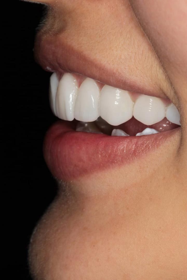 Carillas disilicato de litio – Caso de éxito Prótesis dental – Dr. Ruben Vives Palmezano