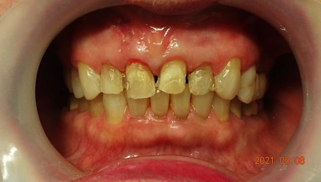 Zirconio y disilicato de litio para diseño de sonrisa