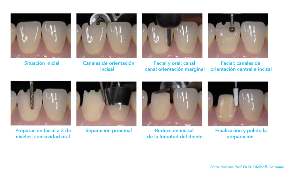 corona anterior 