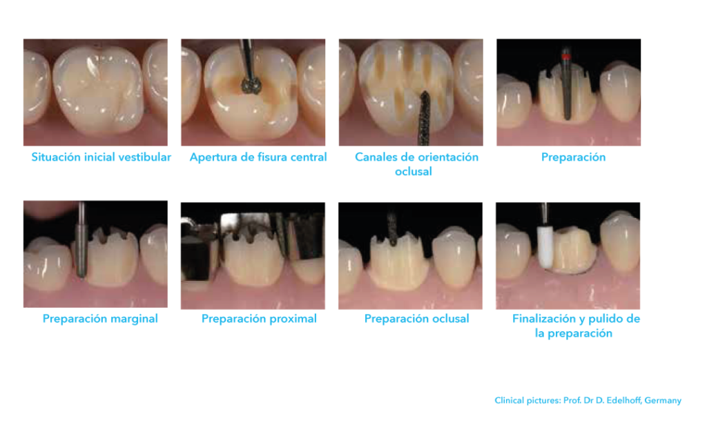 corona posterior