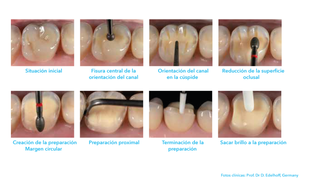 preparacion carilla oclusal foto clínica