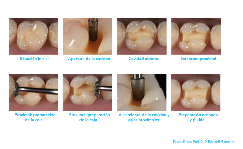 prepracion inlay onlay foto clínica